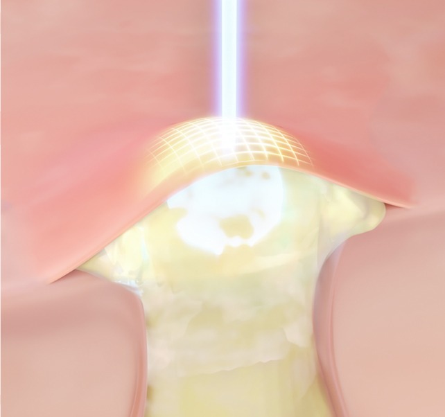 A+激光 image